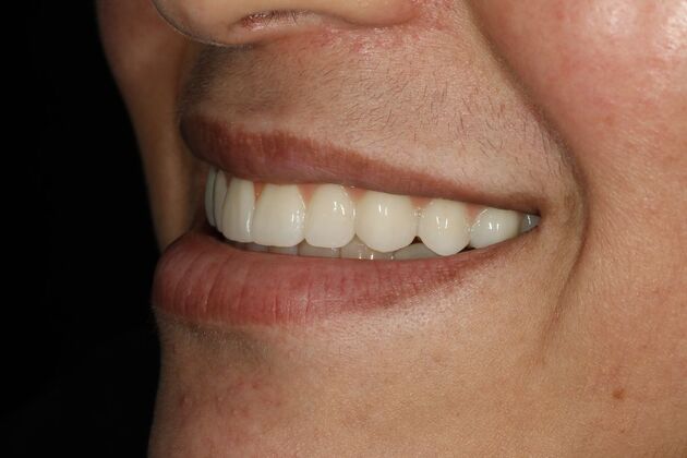 All-on-4 / All-on-X: Case 11 - After