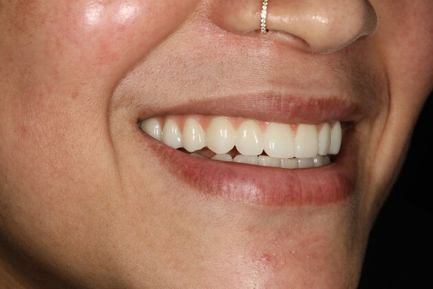 All-on-4 / All-on-X: Case 11 - After