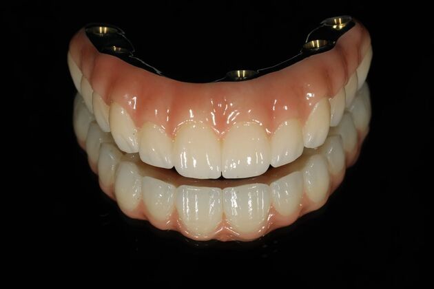 All-on-4 / All-on-X: Case 12 - After