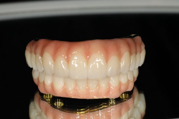 All-on-4 / All-on-X: Case 12 - After