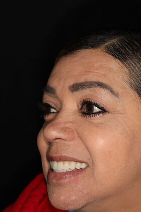 All-on-4 / All-on-X: Case 12 - After