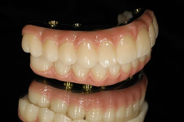 All-on-4 / All-on-X: Case 9 - Before