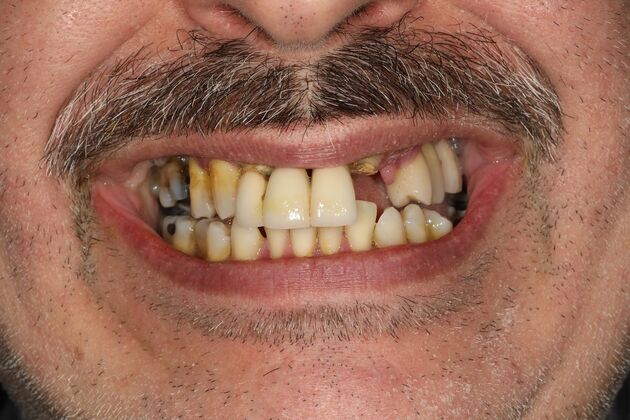 All-on-4 / All-on-X: Case 9 - Before