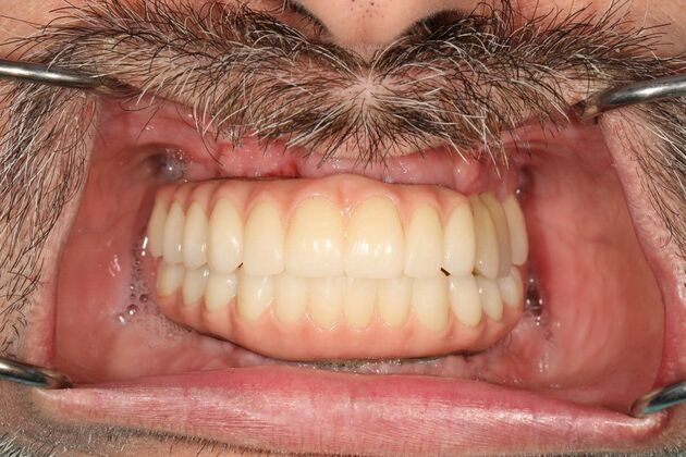 All-on-4 / All-on-X: Case 9 - After