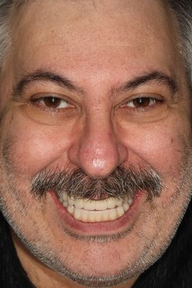 All-on-4 / All-on-X: Case 9 - After