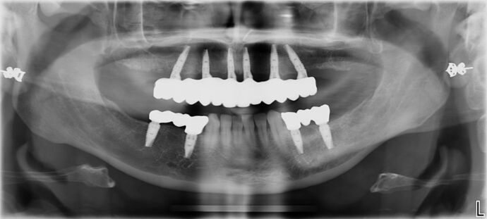 All-on-4 / All-on-X: Case 6 - After