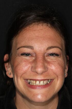 All-on-4 / All-on-X: Case 6 - Before