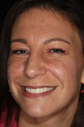 All-on-4 / All-on-X: Case 6 - After