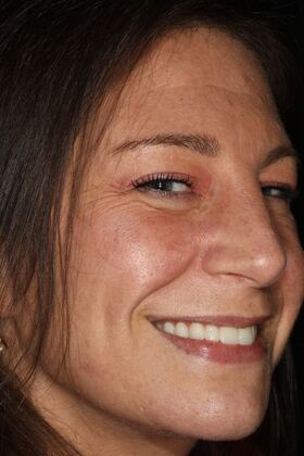 All-on-4 / All-on-X: Case 6 - After