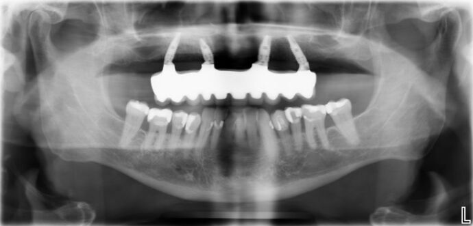 All-on-4 / All-on-X: Case 18 - After