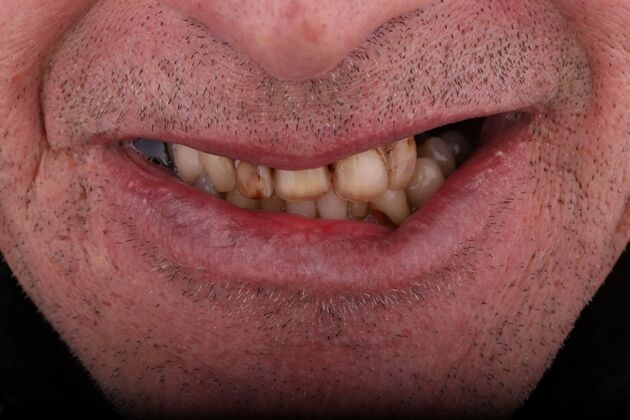 All-on-4 / All-on-X: Case 18 - Before