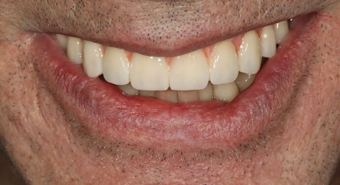 All-on-4 / All-on-X: Case 18 - After