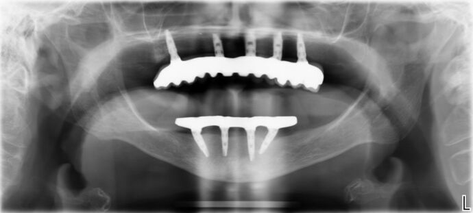 All-on-4 / All-on-X: Case 13 - After
