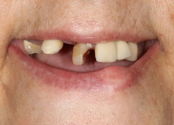 All-on-4 / All-on-X: Case 13 - Before