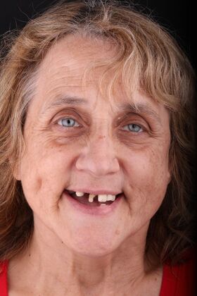 All-on-4 / All-on-X: Case 13 - Before