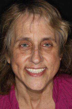 All-on-4 / All-on-X: Case 13 - After