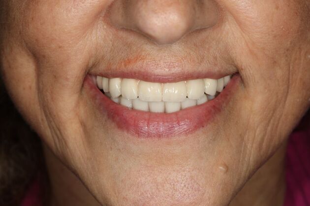 All-on-4 / All-on-X: Case 13 - After