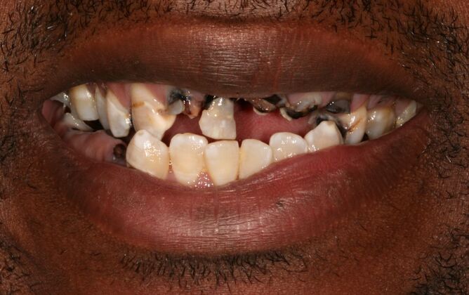 All-on-4 / All-on-X: Case 14 - Before