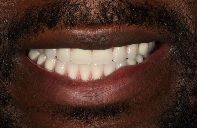 All-on-4 / All-on-X: Case 14 - After