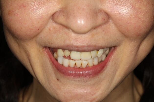 All-on-4 / All-on-X: Case 16 - Before