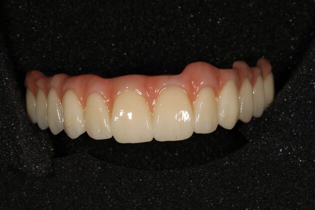 All-on-4 / All-on-X: Case 16 - After