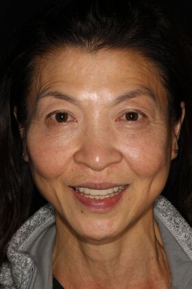 All-on-4 / All-on-X: Case 16 - After