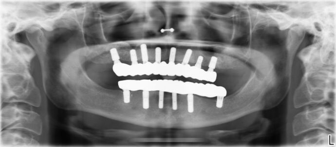 All-on-4 / All-on-X: Case 4 - After