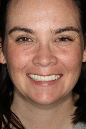 All-on-4 / All-on-X: Case 4 - After