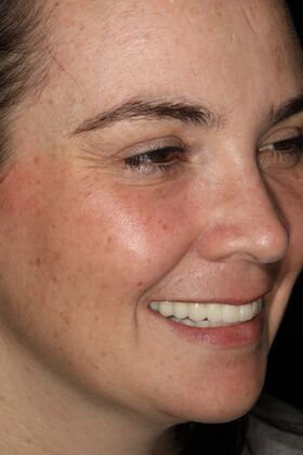 All-on-4 / All-on-X: Case 4 - After