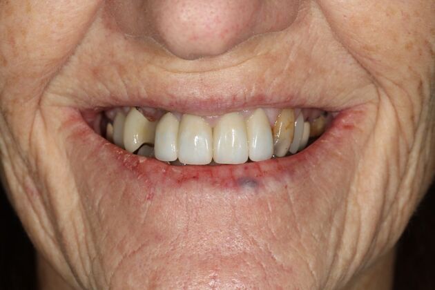 All-on-4 / All-on-X: Case 5 - Before