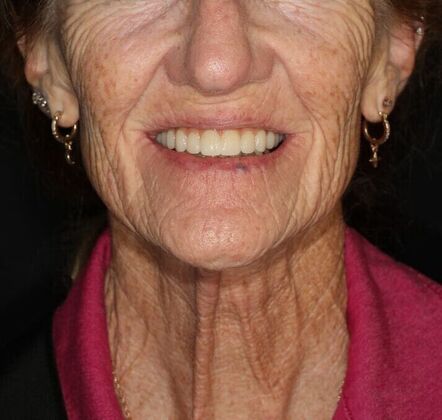 All-on-4 / All-on-X: Case 5 - After