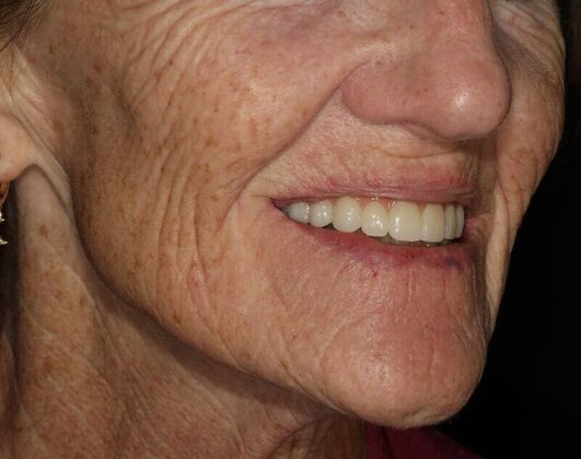 All-on-4 / All-on-X: Case 5 - After