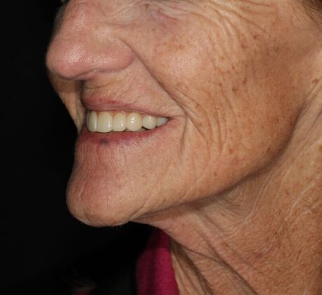 All-on-4 / All-on-X: Case 5 - After