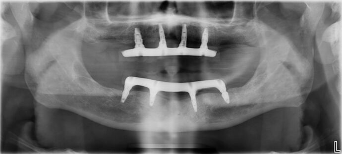 All-on-4 / All-on-X: Case 10 - After