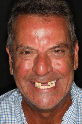 All-on-4 / All-on-X: Case 10 - Before