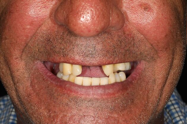 All-on-4 / All-on-X: Case 10 - Before