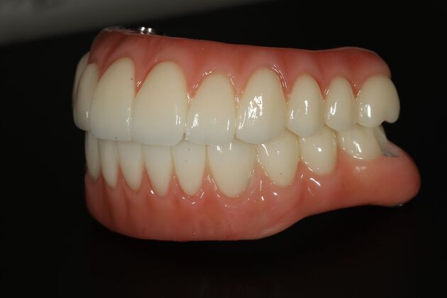 All-on-4 / All-on-X: Case 10 - After