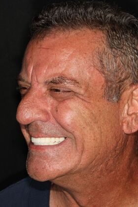 All-on-4 / All-on-X: Case 10 - After