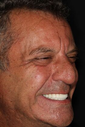 All-on-4 / All-on-X: Case 10 - After