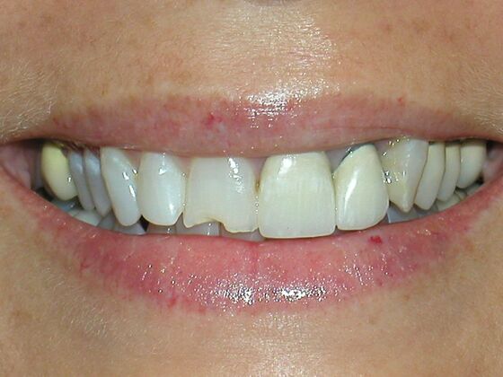 Smile Makeover & Veneers: Case 37 - Before