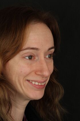 Porcelain Veneers: Lauren - smile make over - Before