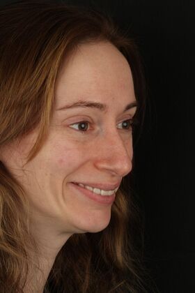 Porcelain Veneers: Lauren - smile make over - After