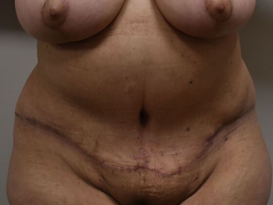 Tummy Tuck (Abdominoplasty): Case 511 - After