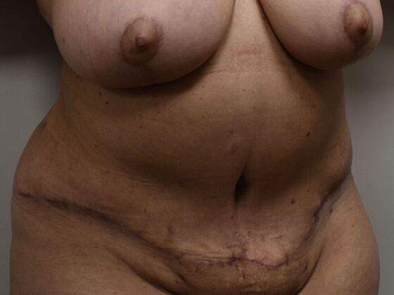 Tummy Tuck (Abdominoplasty): Case 511 - After