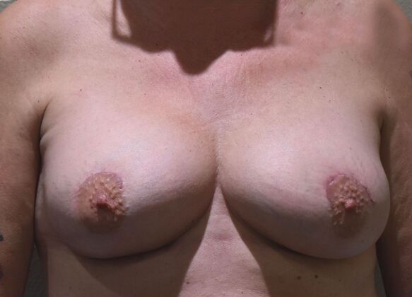 Breast Revision: Case 272 - After