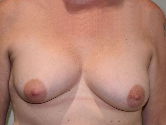 Breast Revision: Case 272 - Before