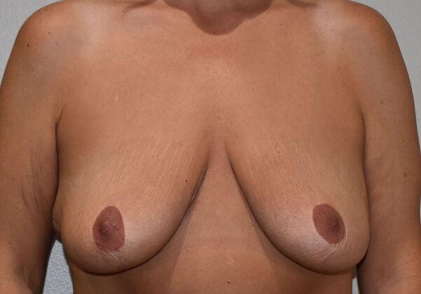 Breast Revision: Case 273 - Before