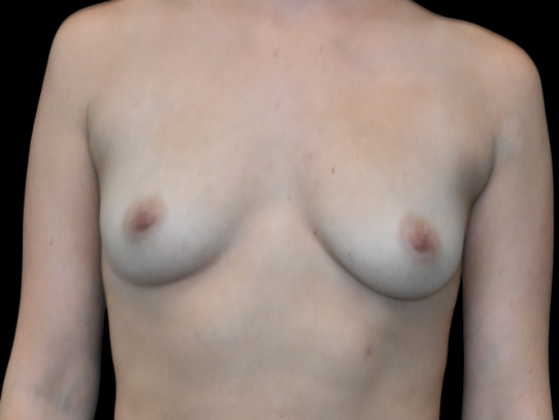 Breast Augmentation: Case 20 - Before