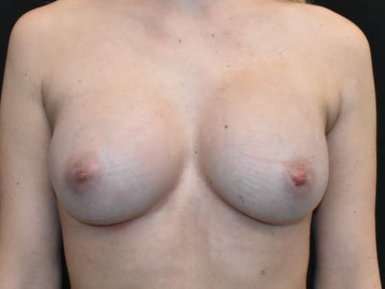 Breast Augmentation: Case 20 - After