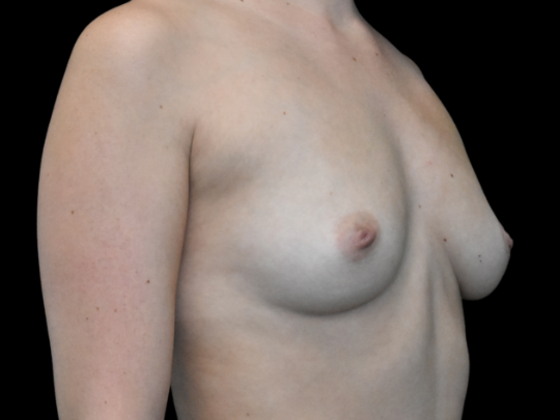 Breast Augmentation: Case 20 - Before